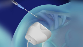 Ultrasonografi (USG) Eşliğinde Enjeksiyon